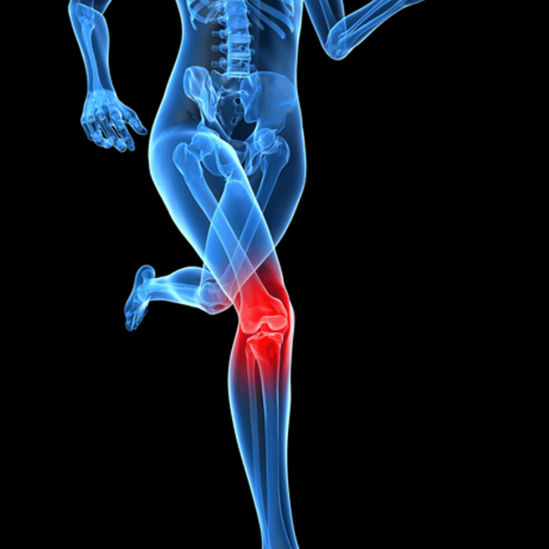 bilateral knee osteoarthritis