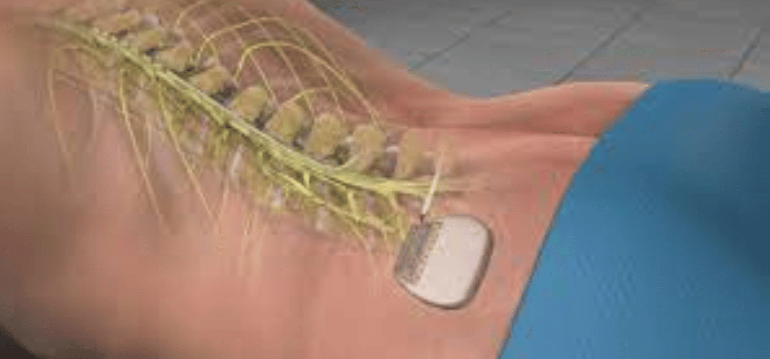 best Spinal Cord Stimulation Pain Hospitals in Pune